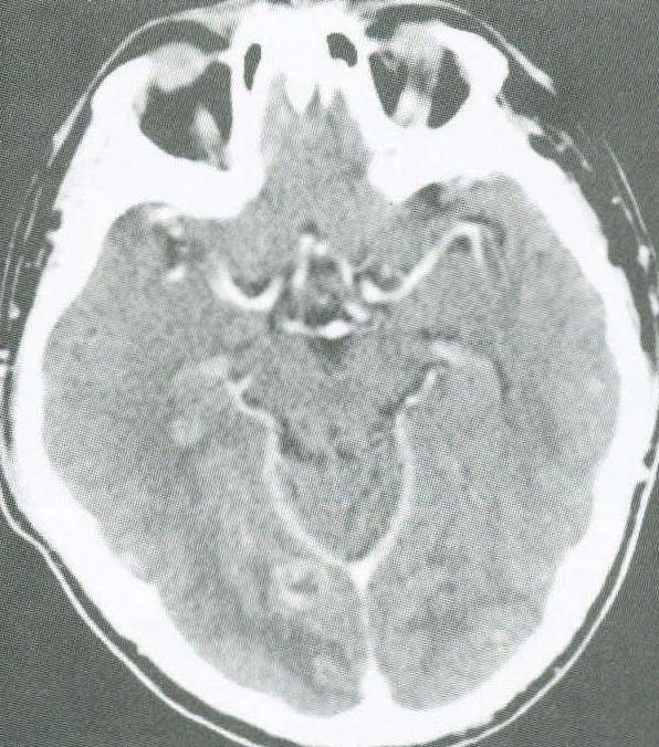 颅脑CT平扫和增强检查